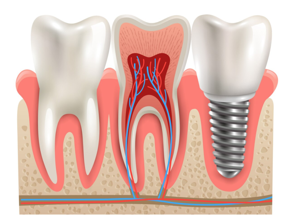 Dental Implant